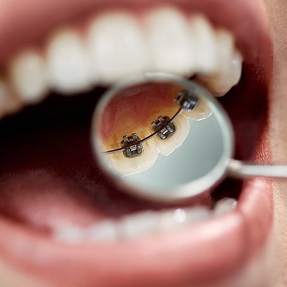 Lingual braces