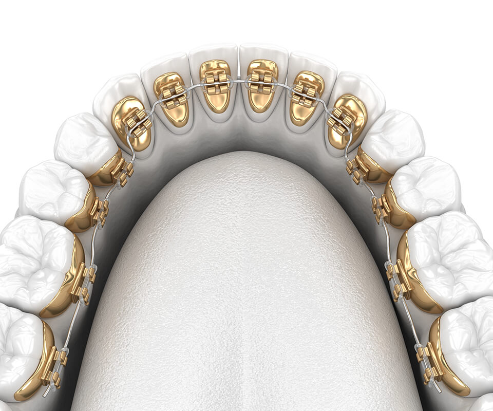 What are lingual braces?